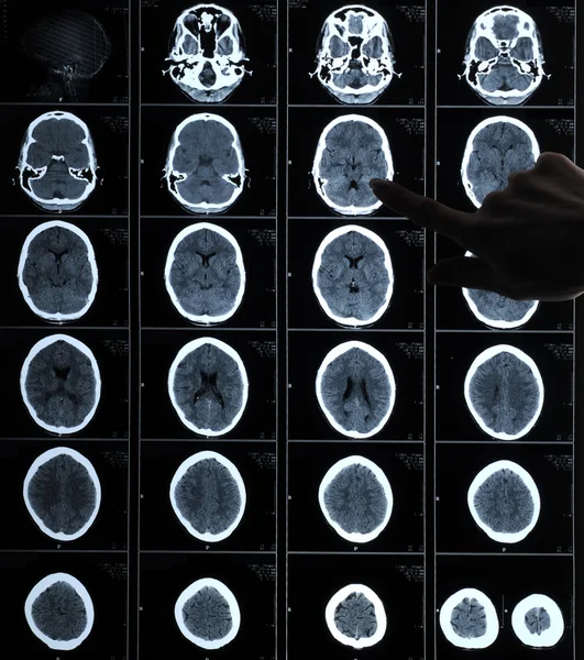 CT photography of human brain — Stock Photo, Image