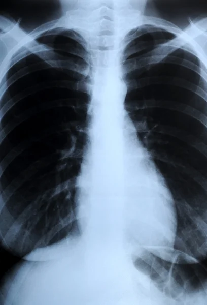 Рентгенография груди человека — стоковое фото