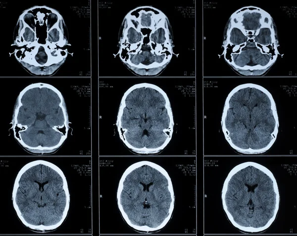 CT photography of human brain — Stock Photo, Image
