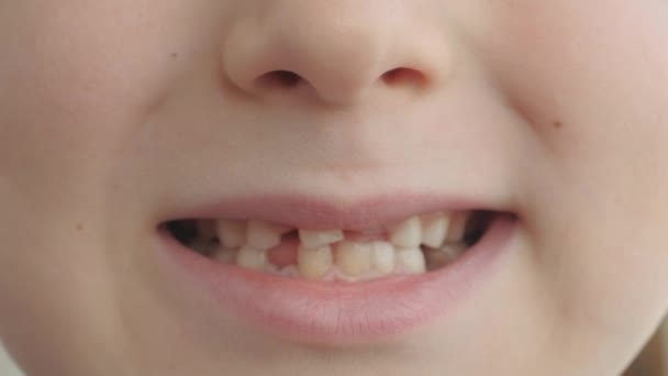 Mudança de dentes de leite em uma criança. — Vídeo de Stock