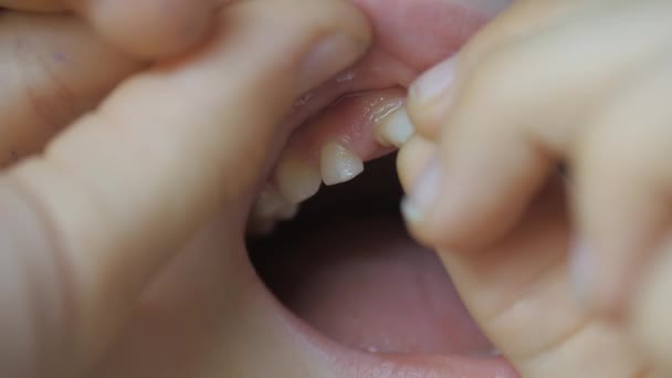 Cambio dei denti da latte in un bambino. — Video Stock