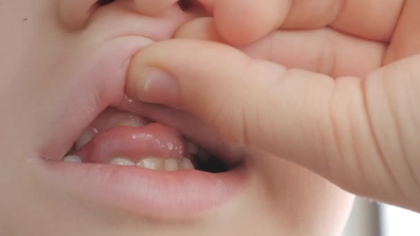 Mudança de dentes de leite em uma criança. — Vídeo de Stock