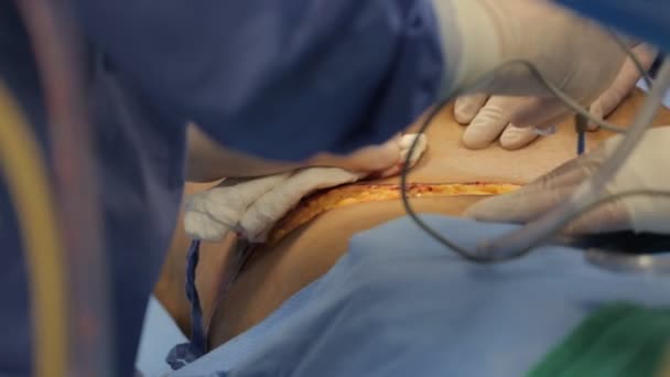 Chirurgia plastyczna na sali operacyjnej — Wideo stockowe
