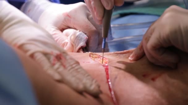 Πλαστική χειρουργική ένα χειρουργείο — Αρχείο Βίντεο