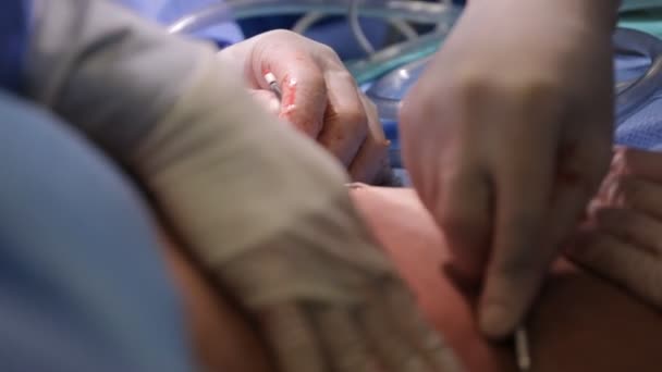 Plastische chirurgie een operatiekamer — Stockvideo