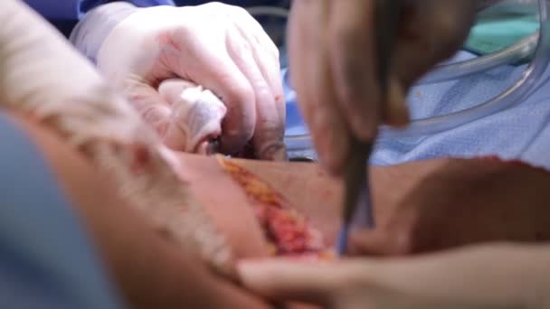 Πλαστική χειρουργική ένα χειρουργείο — Αρχείο Βίντεο