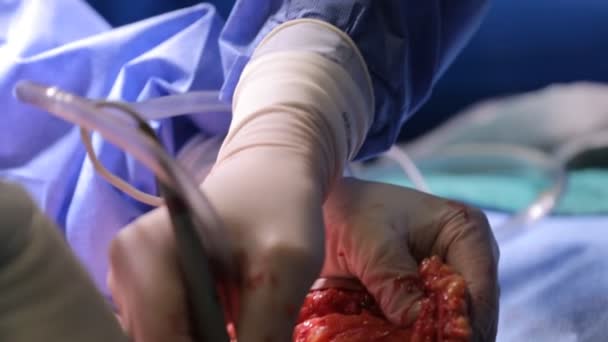 Plastische Chirurgie ein Operationssaal — Stockvideo