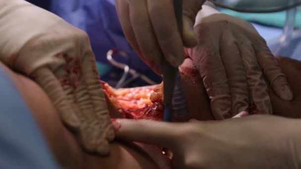 Chirurgie plastique une salle d'opération — Video