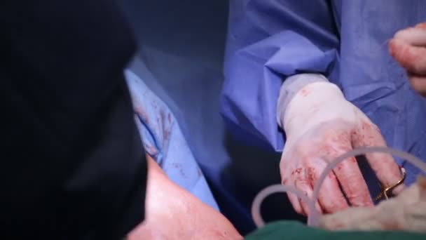 Cirurgia plástica uma sala de cirurgia — Vídeo de Stock