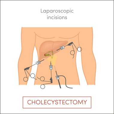 Cholecystectomy Free Vector Eps Cdr Ai Svg Vector Illustration Graphic Art