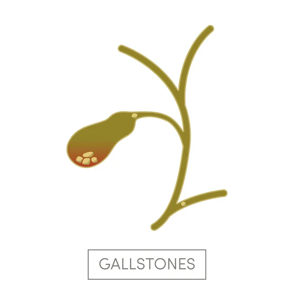 Cholelithiasis - penyakit gallstone - Stok Vektor