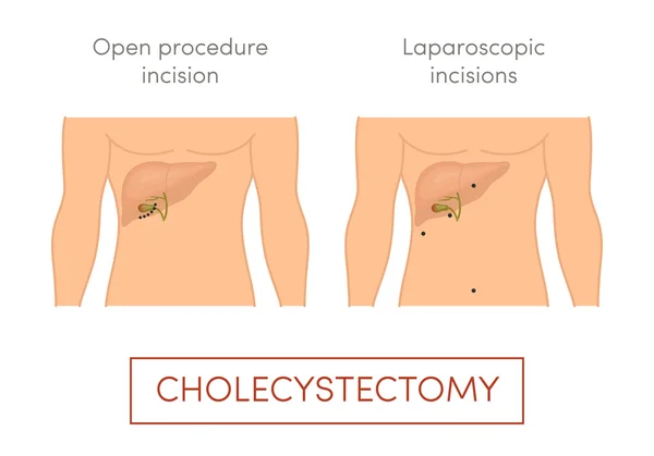 Cartoon cholecystectomie illustratie — Stockvector