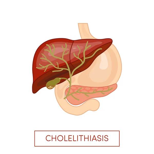 Cholelithiasis - gallstone disease — Stock Vector