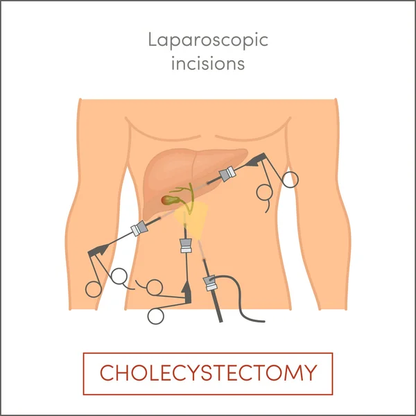 Ablation chirurgicale de la vésicule biliaire — Image vectorielle