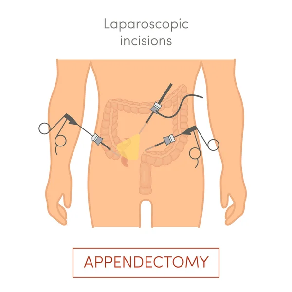 Хирургическое удаление аппендикса — стоковый вектор