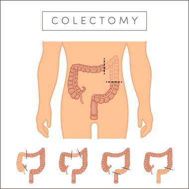 illustration types of colectomy  clipart