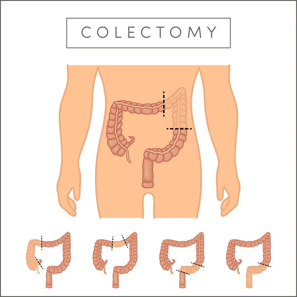 Illustration types of colectomy — Stock Vector