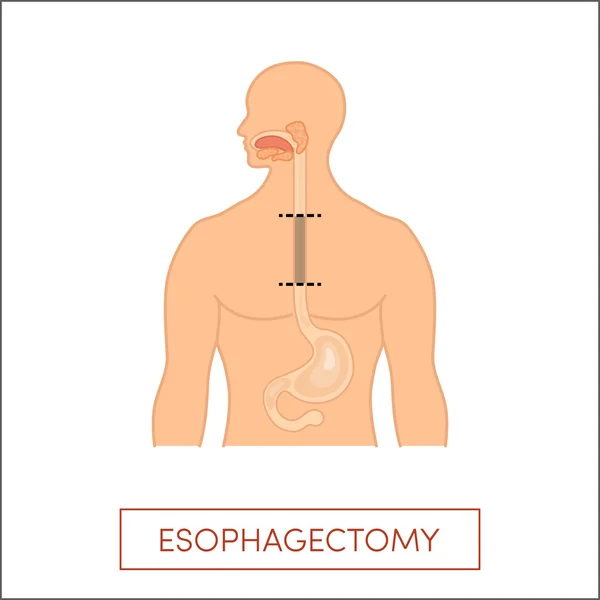 Partial excision of esophagus — Stock Vector