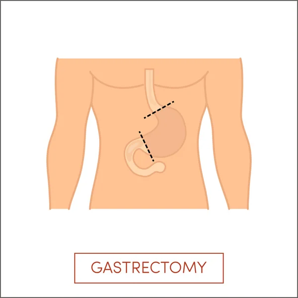 Celkem gastrektomie ilustrace — Stockový vektor