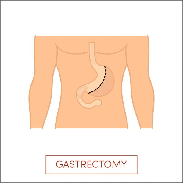 Vertical gastrectomy illustration — Stock Vector
