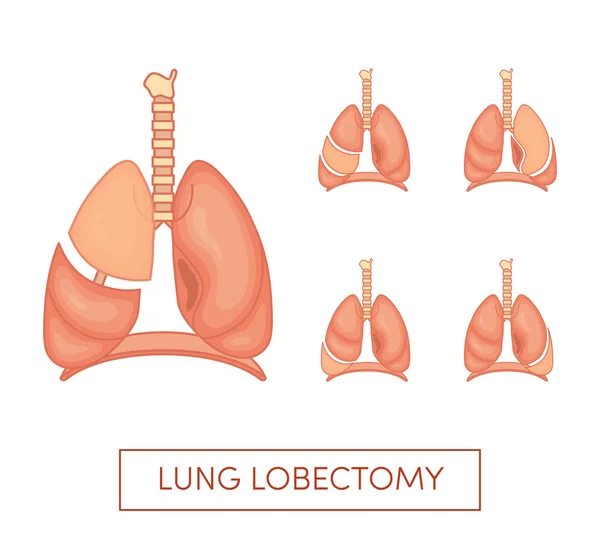 Ilustração da lobectomia pulmonar — Vetor de Stock