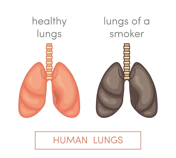 Ilustracja płuca palacza — Wektor stockowy