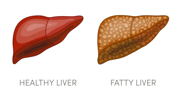 脂肪性肝疾患 — ストックベクタ