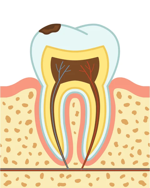 Caries dental ilustración — Vector de stock