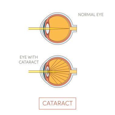Cataract eye illustration clipart