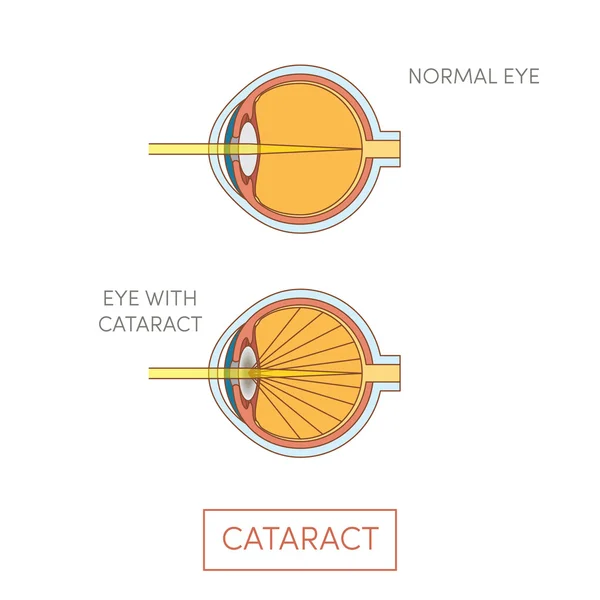 Cataract eye illustration — Stock Vector