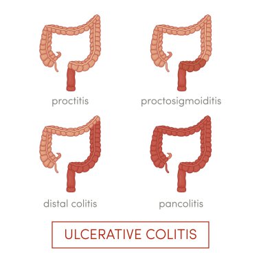 Types of ulcerative colitis clipart