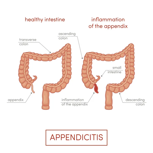 Inflammation de l'appendice bande dessinée — Image vectorielle