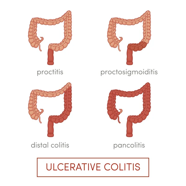 Arten von Colitis ulcerosa lizenzfreie Stockillustrationen
