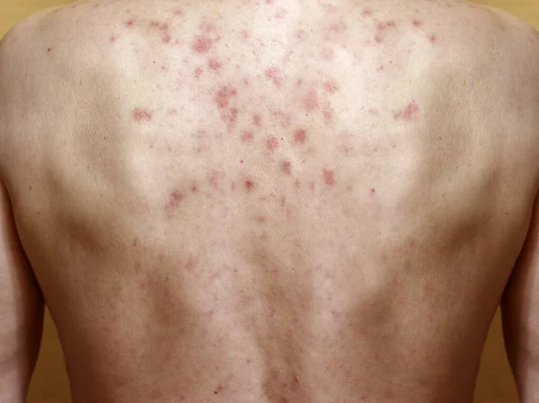Dermatitis on skin of a man`s back. Allergic reaction. Allergic rash on chest skin. Dermatitis. Seborrheic dermatitis