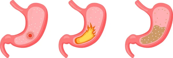 Шлунок здоровий шлунок хворий набір 2 — стоковий вектор