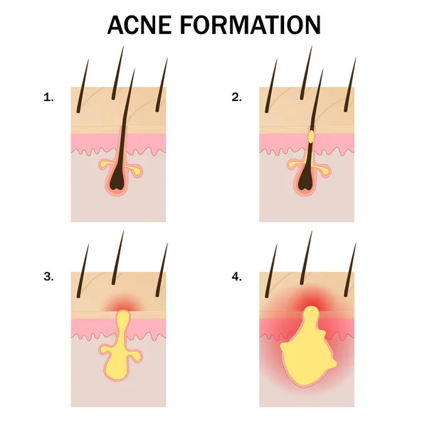 Formação de acne —  Vetores de Stock