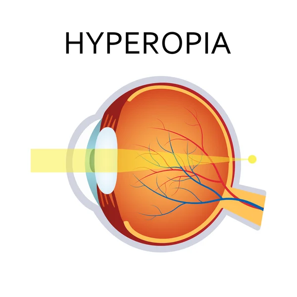 Hiperopia gangguan penglihatan . - Stok Vektor