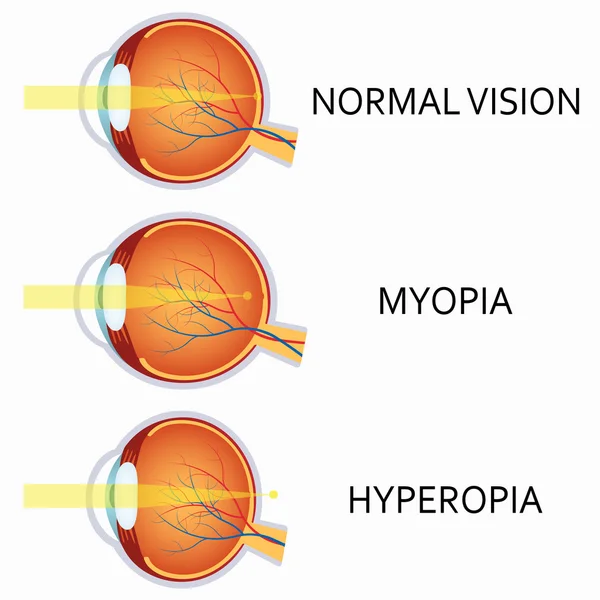 Defeitos oculares humanos ópticos. Miopia e hipermetropia . —  Vetores de Stock