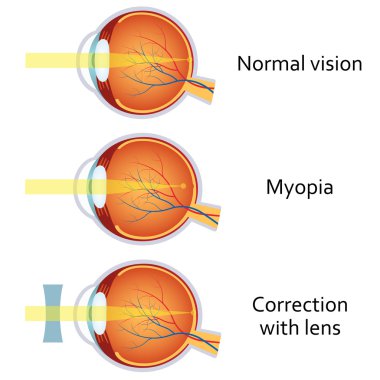 Miyopi ve miyopi eksi bir lens tarafından düzeltildi.