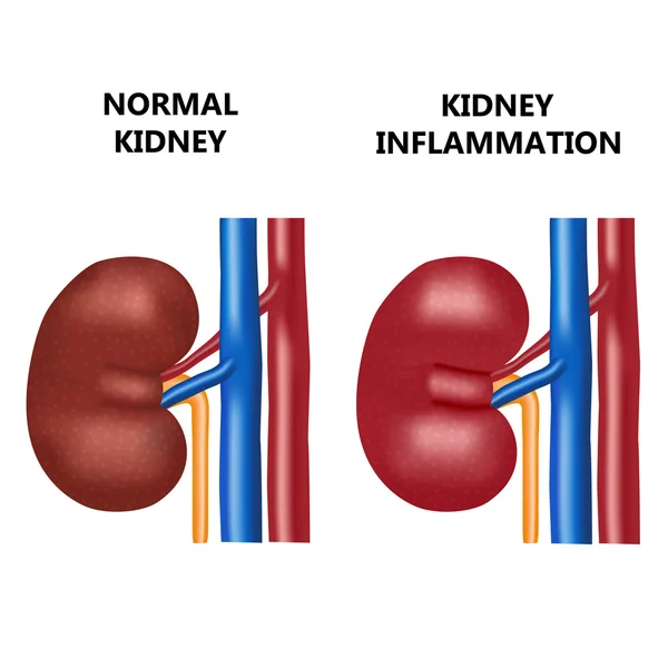 Infección renal y renal saludable . — Archivo Imágenes Vectoriales