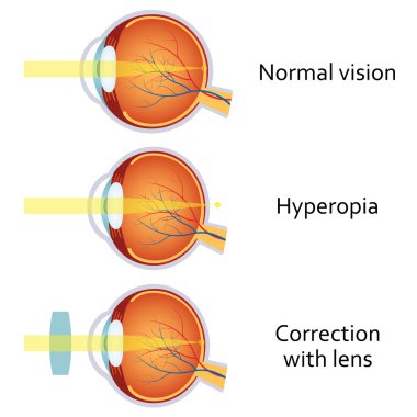 Hipermetropi artı bir lens tarafından düzeltildi