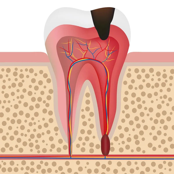 Illustration of infected tooth — Stock Vector