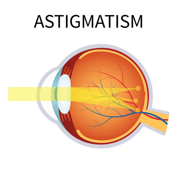 Astigmatism. Eyesight problem, blurred vision. — Stock Vector