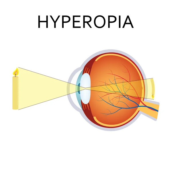 Trastorno de la vista por hiperopía . — Vector de stock