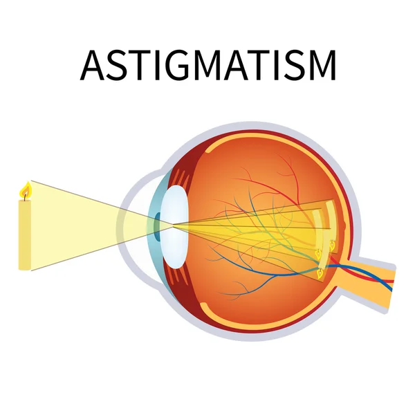 Ilustración del astigmatismo . Ilustraciones de stock libres de derechos