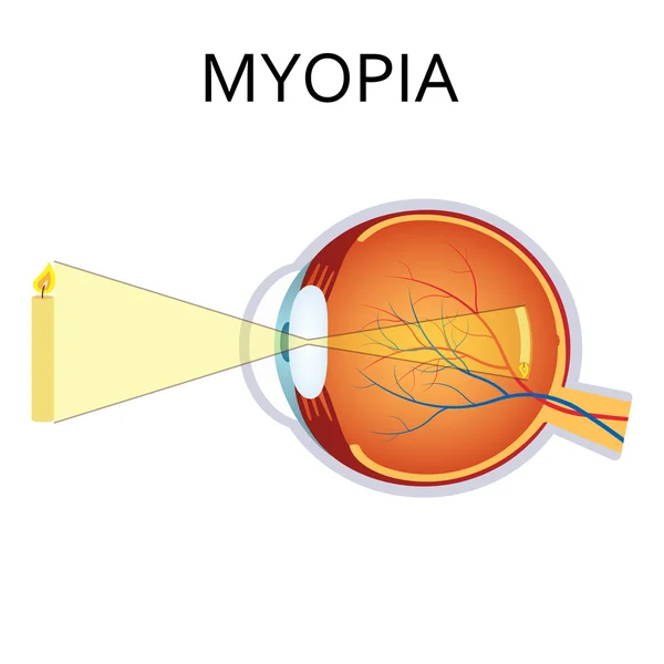 Ilustración de la miopía . Vectores de stock libres de derechos