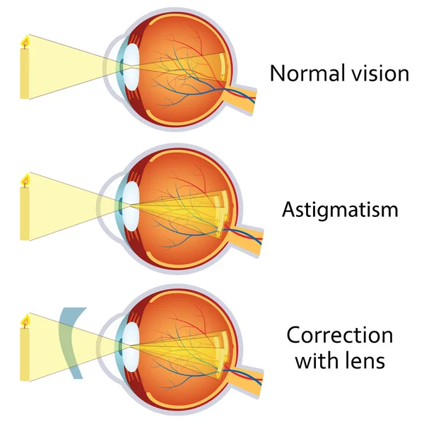 Astigmatismo corretto da una lente cilindrica . — Vettoriale Stock