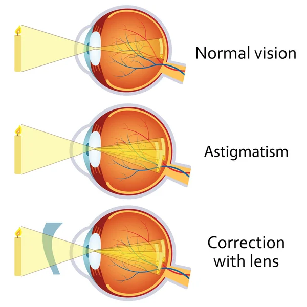 Astigmat silindirik bir lens tarafından düzeltildi. — Stok Vektör