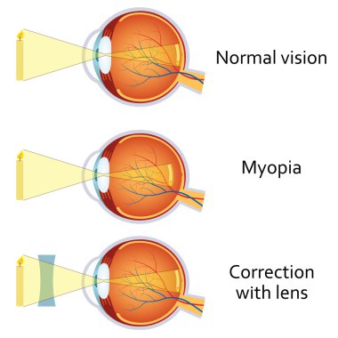 Miyopi ve miyopi eksi bir lens tarafından düzeltildi.
