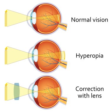 Hipermetropi artı bir lens tarafından düzeltildi.